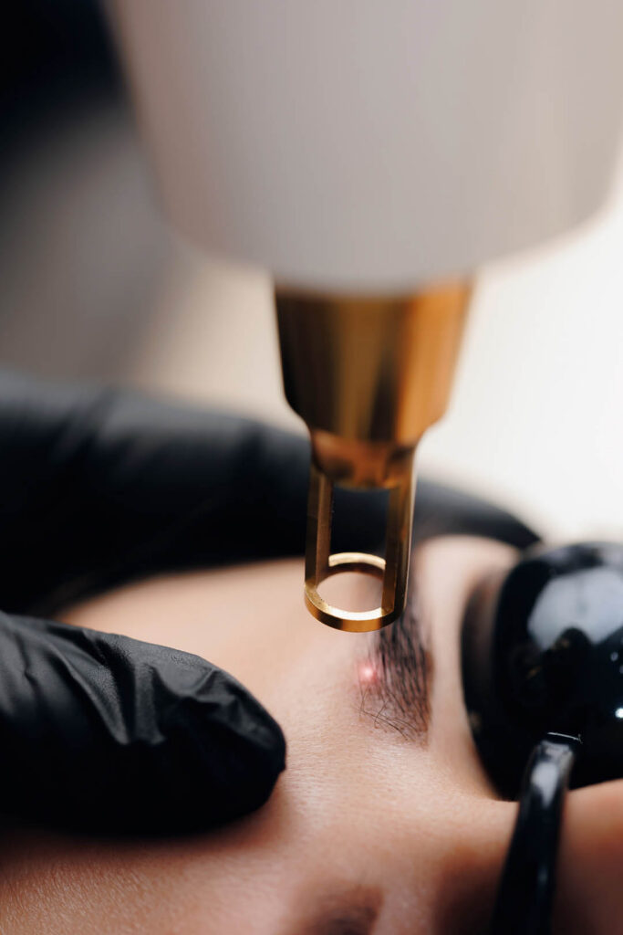 Laser removal of tattoo permanent makeup eyebrow of young woman in salon.